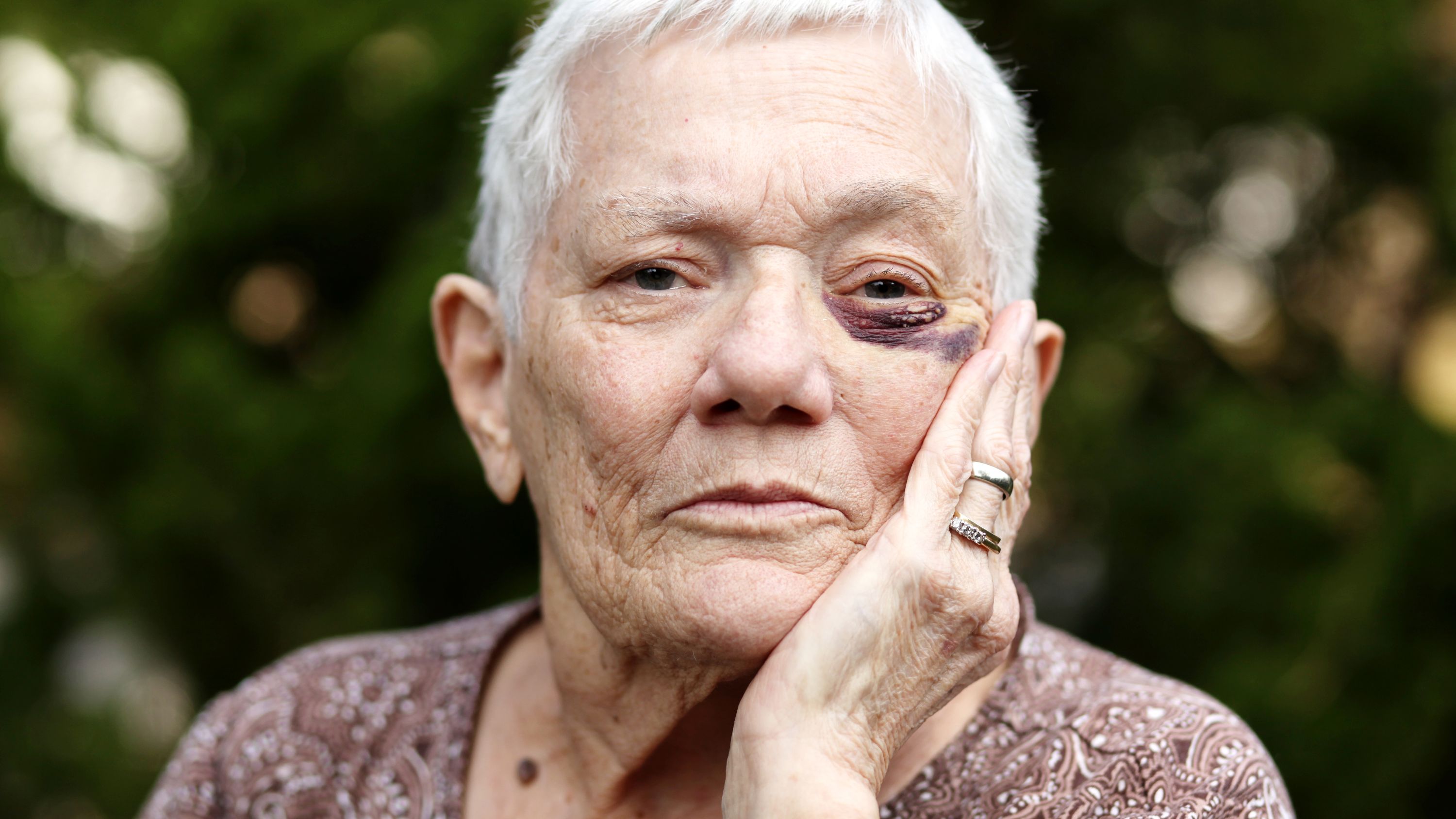 Eine ältere Frau mit blauem Auge.