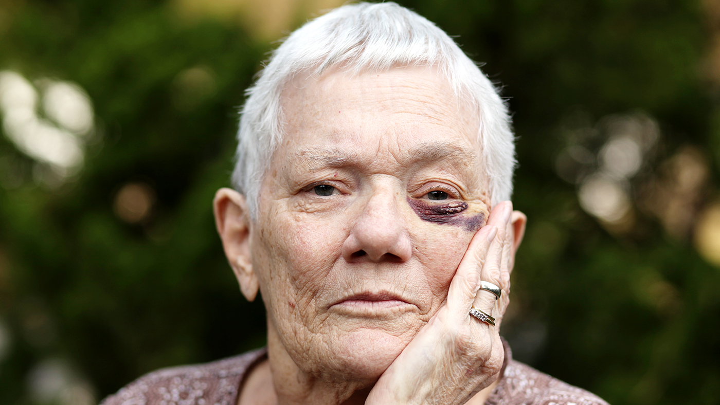 Une dame âgée avec un œil au beurre noir regarde la caméra d'un air pensif.